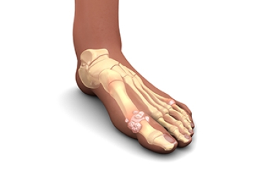 Definition and Symptoms of Gout in Children