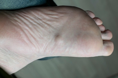 Understanding Plantar Fibromatosis