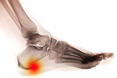 Causes and Prevention of Heel Spurs