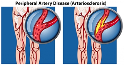 Dangers of Peripheral Artery Disease