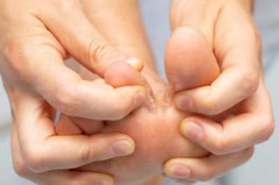 Understanding Athlete&#039;s Foot and How to Prevent It