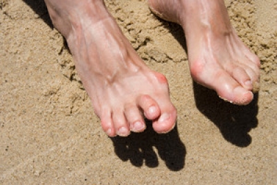 Understanding Hammertoe